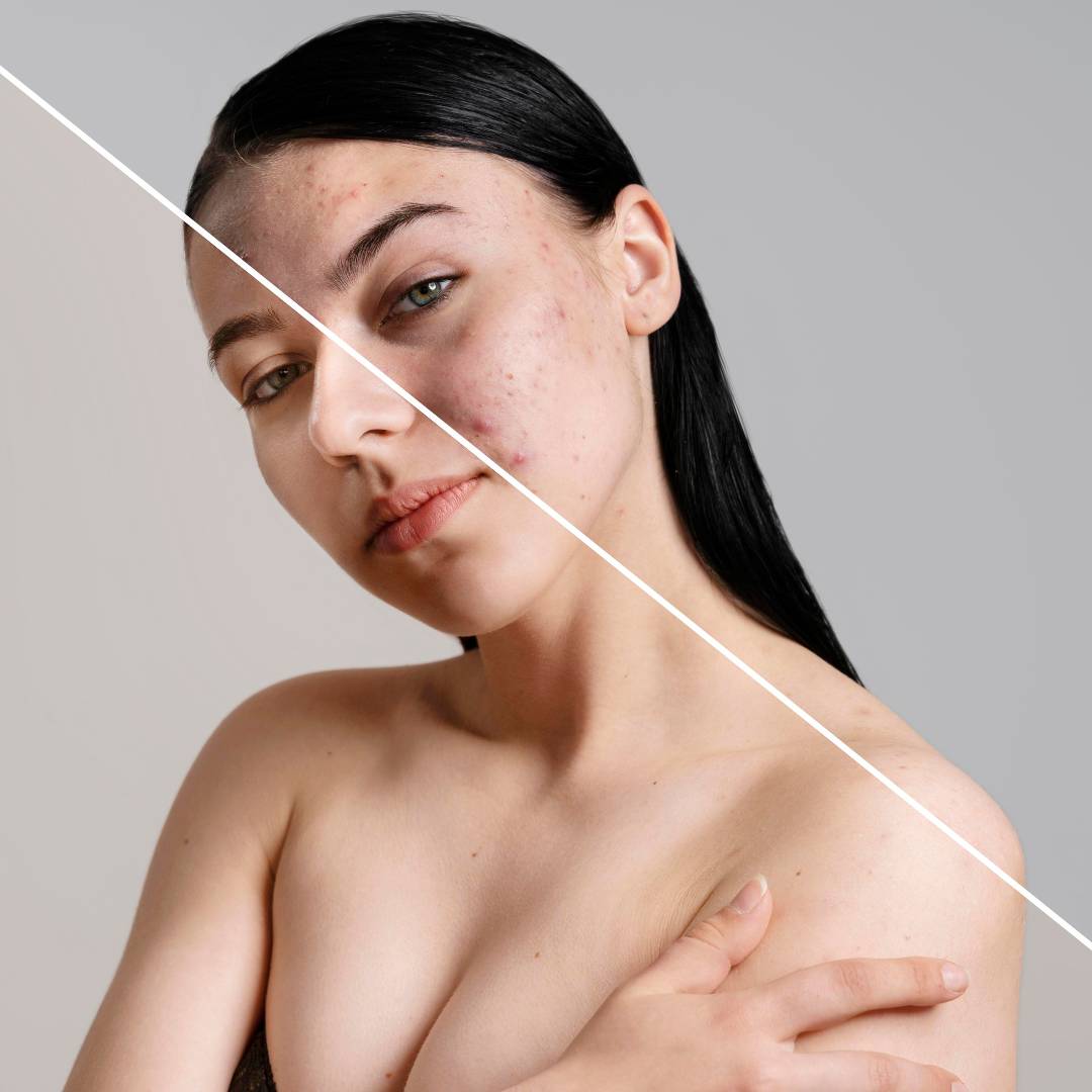 Cremă Profesională  Împotriva Petelor Pielii