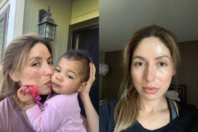 Cremă Profesională  Împotriva Petelor Pielii