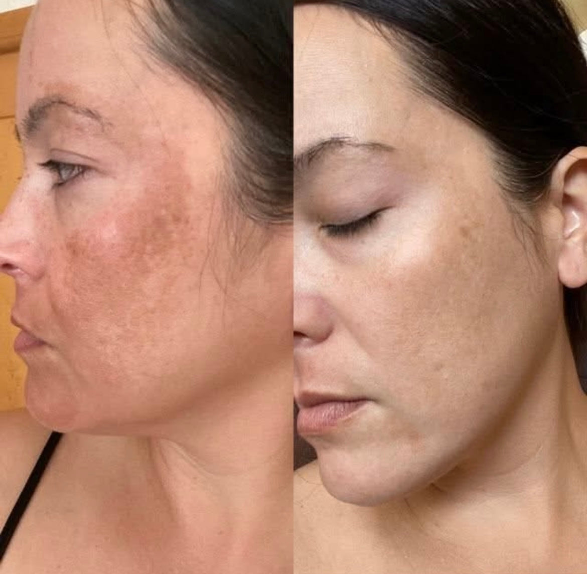 Cremă Profesională  Împotriva Petelor Pielii