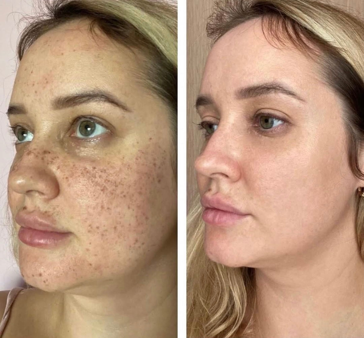 Cremă Profesională  Împotriva Petelor Pielii