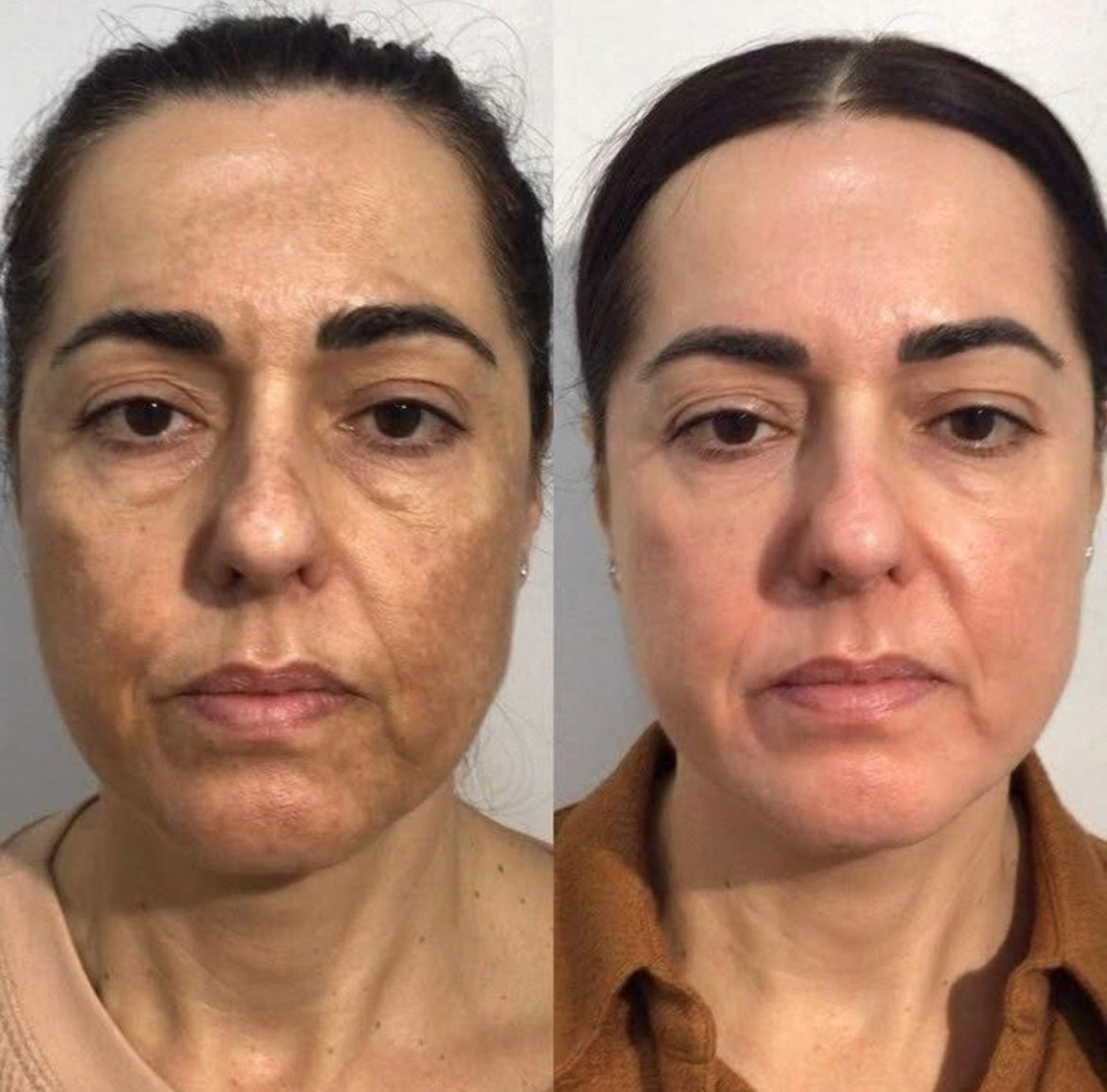 Cremă Profesională  Împotriva Petelor Pielii