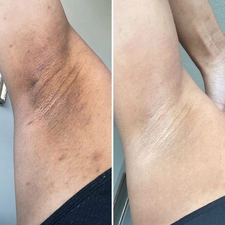 Cremă Profesională  Împotriva Petelor Pielii