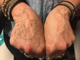 Cremă Profesională  Împotriva Petelor Pielii