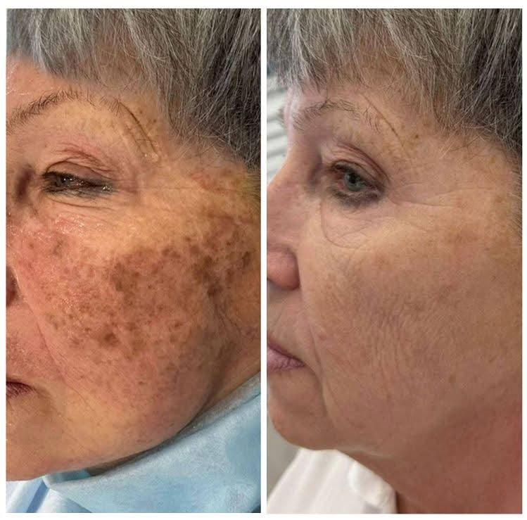 Cremă Profesională  Împotriva Petelor Pielii