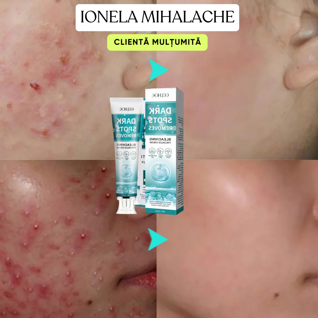 Crema Profesională de Albire și Împotriva Petelor pielii